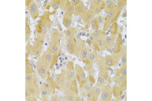 Immunohistochemistry of paraffin-embedded human liver cancer using SNAI2 Antibody (ABIN5970416) at dilution of 1/100 (40x lens). (SLUG 抗体)
