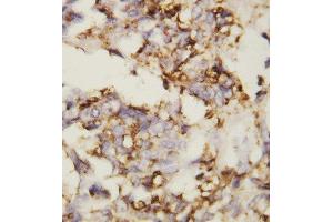 Anti-N Cadherin antibody, IHC(P) IHC(P): Human Ovary Cancer Tissue (N-Cadherin 抗体  (Middle Region))
