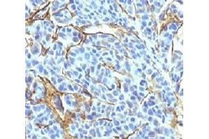 Formalin-fixed, paraffin-embedded human melanoma stained with NGFR antibody (NTR/912). (NGFR 抗体)