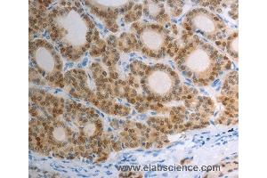 Immunohistochemistry of Human thyroid cancer using S100A1 Polyclonal Antibody at dilution of 1:40 (S100A1 抗体)