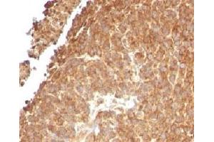 IHC testing of FFPE human melanoma with TOP1MT antibody (clone TPIMT-1). (TOP1MT 抗体)