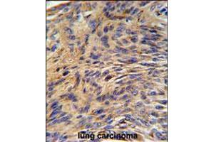 HSPA5 Antibody IHC analysis in formalin fixed and paraffin embedded human lung carcinoma followed by peroxidase conjugation of the secondary antibody and DAB staining. (GRP78 抗体  (AA 261-289))