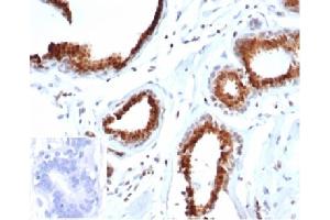 Formalin-fixed, paraffin-embedded human breast carcinoma stained with p27 Recombinant Mouse Monoclonal Antibody (rKIP1/1356). (Recombinant CDKN1B 抗体)