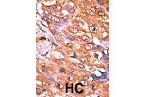 Formalin-fixed and paraffin-embedded human cancer tissue reacted with the primary antibody, which was peroxidase-conjugated to the secondary antibody, followed by AEC staining. (PDGFRB 抗体  (pTyr579))