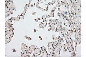 Immunohistochemical staining of paraffin-embedded Adenocarcinoma of breast tissue using anti-BUB1B mouse monoclonal antibody. (BUB1B 抗体)