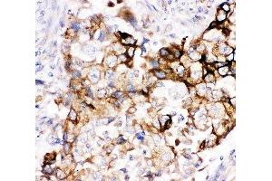 IHC-P: Heme Oxygenase 2 antibody testing of human lung cancer tissue (HMOX2 抗体  (AA 2-316))
