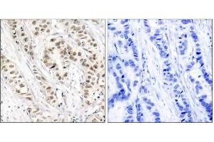 Immunohistochemical analysis of paraffin-embedded human breast carcinoma tissue, using BRCA1 (phospho-Ser1524) antibody (E011117). (BRCA1 抗体  (pSer1524))