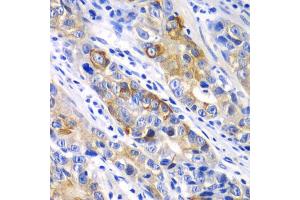 Immunohistochemistry of paraffin-embedded human gastric cancer using BCL2 antibody (ABIN5970041) at dilution of 1/100 (40x lens). (Bcl-2 抗体)