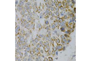 Immunohistochemistry of paraffin-embedded human esophageal cancer using GNAO1 Antibody. (GNAO1 抗体)