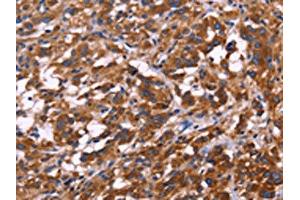 The image on the left is immunohistochemistry of paraffin-embedded Human thyroid cancer tissue using ABIN7129993(KIR2DL3/KIR2DL1/KIR2DL4/KIR2DS4 Antibody) at dilution 1/30, on the right is treated with fusion protein. (KIR2DL3/KIR2DL1/KIR2DL4/KIR2DS4 抗体)