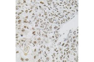 Immunohistochemistry of paraffin-embedded human lung cancer using FAF1 antibody (ABIN5975642) (40x lens). (FAF1 抗体)