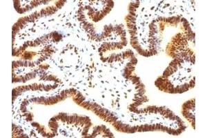 Formalin-fixed, paraffin-embedded human ovarian carcinoma stained with SUMO-1 antibody (SUMO1/1188) (SUMO1 抗体)