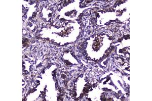 IHC testing of FFPE human lung cancer tissue with TLR1 antibody at 1ug/ml. (TLR1 抗体)