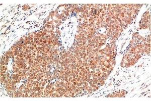 Immunohistochemistry of paraffin-embedded Human breast carcinoma tissue using ATM Monoclonal Antibody at dilution of 1:200. (ATM 抗体)