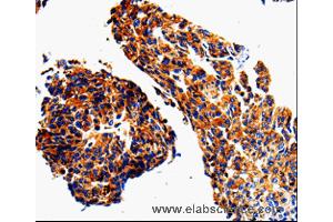 Immunohistochemistry of Human lung cancer using ADD1 Polyclonal Antibody at dilution of 1:50 (alpha Adducin 抗体)