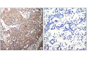 Immunohistochemical analysis of paraffin-embedded human breast carcinoma tissue using Keratin 18 (Ab-33) antibody (E021306). (Cytokeratin 18 抗体)