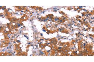 Immunohistochemistry of paraffin-embedded Human thyroid cancer tissue using HCAR2 Polyclonal Antibody at dilution 1:40 (HCAR2 抗体)