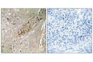 Immunohistochemistry analysis of paraffin-embedded human lung carcinoma tissue using SC6A6 antibody. (TAUT 抗体)