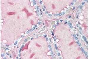 Human Thyroid (formalin-fixed, paraffin-embedded) stained with TG antibody ABIN396966 at 10 ug/ml followed by biotinylated anti-mouse IgG secondary antibody ABIN481714, alkaline phosphatase-streptavidin and chromogen. (Thyroglobulin 抗体)