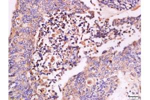 Paraformaldehyde-fixed, paraffin embedded human colon carcinoma tissue, Antigen retrieval by boiling in sodium citrate buffer(pH6) for 15min, Block endogenous peroxidase by 3% hydrogen peroxide for 30 minutes, Blocking buffer (normal goat serum) at 37°C for 20min, Antibody incubation with Rabbit Anti-IFN-beta Polyclonal Antibody, Unconjugated  at 1:500 overnight at 4°C, followed by a conjugated secondary and DAB staining (IFNB1 抗体  (AA 101-187))