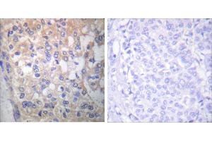 P-peptide - +Immunohistochemical analysis of paraffin-embedded human breast carcinoma tissue using Fyn (Phospho-Tyr530) antibody (#A0430). (FYN 抗体  (pTyr530))