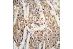 Formalin-fixed and paraffin-embedded human breast carcinoma tissue reacted with PKM2 antibody (C-term), which was peroxidase-conjugated to the secondary antibody, followed by DAB staining. (PKM2 抗体  (C-Term))