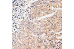 Immunohistochemistry of paraffin-embedded human liver cancer using WNK3 antibody (ABIN6132518, ABIN6150236, ABIN6150237 and ABIN6221221) at dilution of 1:100 (40x lens). (WNK3 抗体)