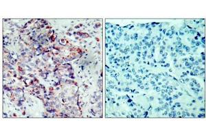 Immunohistochemical analysis of paraffin-embedded human breast carcinoma tissue, using SEK1/MKK4 (phospho-Ser80) antibody (E011177). (MAP2K4 抗体  (pSer80))