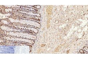 Immunohistochemistry of paraffin-embedded Human colon tissue using CD2 Monoclonal Antibody at dilution of 1:200. (CD2 抗体)