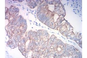 Immunohistochemical analysis of paraffin-embedded colon cancer tissues using KRT18 mouse mAb with DAB staining. (Cytokeratin 18 抗体  (AA 1-150))