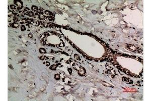 Immunohistochemistry (IHC) analysis of paraffin-embedded Human Breast Cancer, antibody was diluted at 1:100. (Histone 3 抗体  (2meLys10))