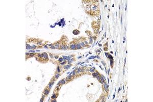 Immunohistochemistry of paraffin-embedded human stomach cancer using FABP3 antibody (ABIN5973057) at dilution of 1/200 (40x lens). (FABP3 抗体)