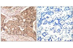 Immunohistochemical analysis of paraffin-embedded human breast carcinoma tissue using Paxillin (phospho-Tyr118) antibody (E011089). (Paxillin 抗体  (pTyr118))
