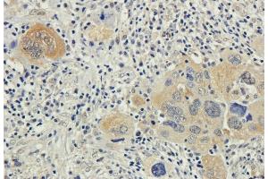 Immunohistochemical staining of human lung cancer using anti-Bax antibody. (Recombinant Bax (Active Monomer) (AA 12-24), (AA 3-16) 抗体)