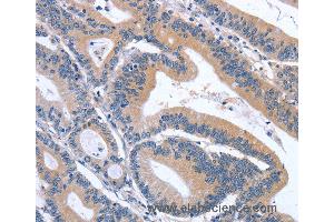 Immunohistochemistry of Human lymphoma using GDF11 Polyclonal Antibody at dilution of 1:30 (GDF11 抗体)