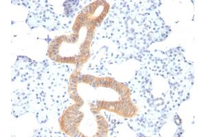 Formalin-fixed, paraffin-embedded human Melanoma stained with CD86 Mouse Monoclonal Antibody (SPM600). (CD86 抗体)