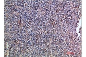 Immunohistochemical analysis of paraffin-embedded human-kidney-cancer, antibody was diluted at 1:200. (EGF 抗体  (AA 1000-1060))