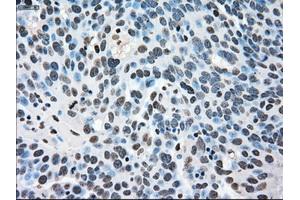 Immunohistochemical staining of paraffin-embedded Adenocarcinoma of breast tissue using anti-MAPK1 mouse monoclonal antibody. (ERK2 抗体)