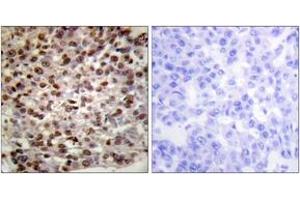 Immunohistochemistry analysis of paraffin-embedded human breast carcinoma tissue, using Histone H2B (Acetyl-Lys15) Antibody. (Histone H2B 抗体  (acLys15))