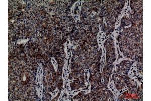 Immunohistochemistry (IHC) analysis of paraffin-embedded Human Breast Cancer, antibody was diluted at 1:100. (MCM3 抗体  (Internal Region))