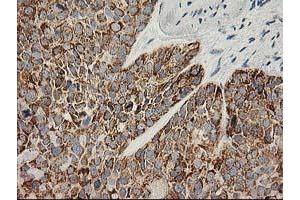 Immunohistochemical staining of paraffin-embedded Adenocarcinoma of Human breast tissue using anti-AK4 mouse monoclonal antibody. (AK4 抗体)