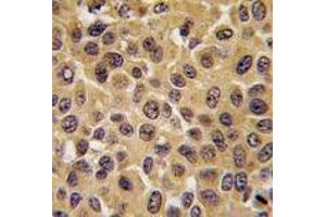 Formalin-fixed and paraffin-embedded human hepatocarcinoma tissue reacted with CDC25B antibody (Center), which was peroxidase-conjugated to the secondary antibody, followed by DAB staining. (CDC25B 抗体  (Center))