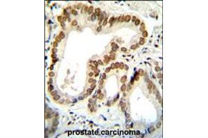 BTG2 Antibody immunohistochemistry analysis in formalin fixed and paraffin embedded human prostate carcinoma followed by peroxidase conjugation of the secondary antibody and DAB staining. (BTG2 抗体  (N-Term))