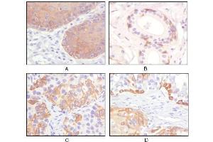 Immunohistochemical analysis of paraffin-embedded human esophagus epithelium (A), salivary gland basal cell (B), lung squamous cell carcinoma (C), endometrium admosquamous carcinoma (D), showing cytoplasmic and membrane localization using CK5 antibody with DAB staining. (Cytokeratin 5 抗体)