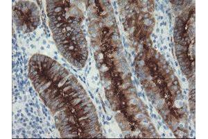 Immunohistochemical staining of paraffin-embedded Adenocarcinoma of Human endometrium tissue using anti-FOLH1 mouse monoclonal antibody. (PSMA 抗体)