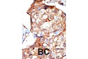 Formalin-fixed and paraffin-embedded human cancer tissue reacted with the primary antibody, which was peroxidase-conjugated to the secondary antibody, followed by DAB staining. (ZAP70 抗体  (AA 252-282))