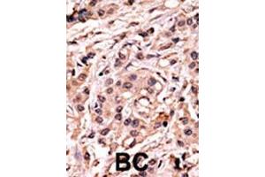 Formalin-fixed and paraffin-embedded human cancer tissue reacted with the primary antibody, which was peroxidase-conjugated to the secondary antibody, followed by AEC staining. (p53 抗体  (pSer20))