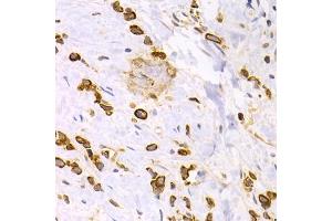 Immunohistochemistry of paraffin-embedded human gastric cancer using KRT15 antibody. (KRT15 抗体)