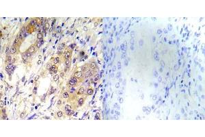 Immunohistochemical analysis of paraffin-embedded human lung carcinoma tissue using Tsc2 (phospho-Thr1462) antibody (E012050). (Tuberin 抗体  (pThr1462))