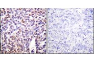 Immunohistochemistry analysis of paraffin-embedded human breast carcinoma tissue, using Histone H4 (Ab-16) Antibody. (Histone H4 抗体  (AA 15-64))